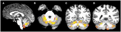 Functional and Structural Brain Damage in Friedreich's Ataxia